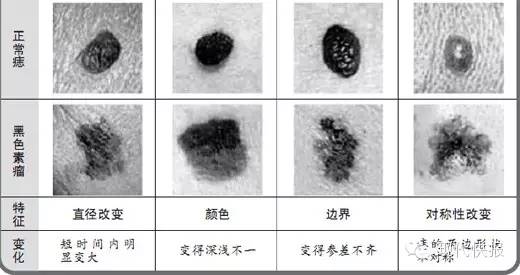 女子腳上黑痣成了惡性瘤，只因常做這件事……身上有痣的要看！